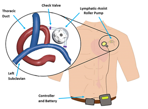 Lymphatic assist pump