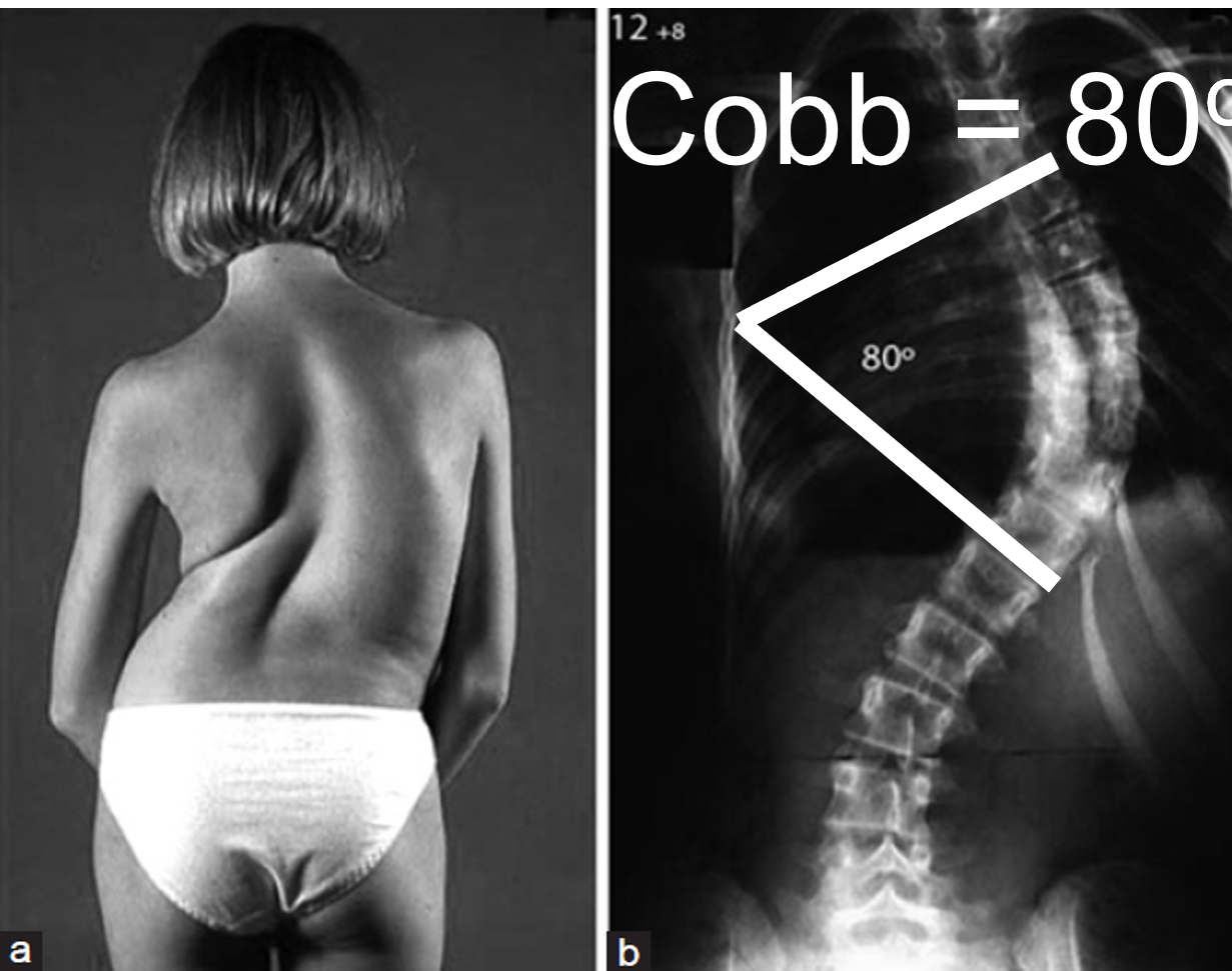 Initial_Cobb_Angle